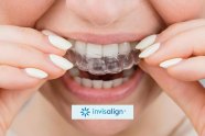 Invisalign Braces What Makes Invisalign Different From Braces 